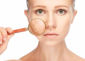 consecuencias del estrés en la piel