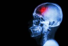 enfermedad vascular cerebral