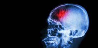 enfermedad vascular cerebral