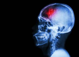 enfermedad vascular cerebral