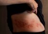 GSK revela qué saben los adultos de 50 a 70 años sobre el hérpes zóster herpes zóster en adultos