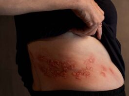 herpes zóster en adultos