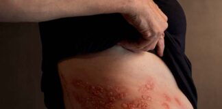 herpes zóster en adultos