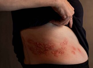 herpes zóster en adultos